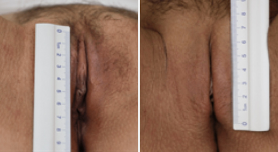 drnikko-before-after-nonsurgical-46433 Vaginal Rejuvenation