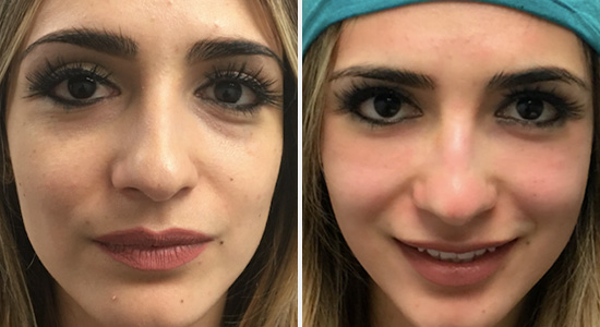 Before After PRP Therapy facial dr Nikko Houston TX